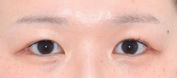 目尻切開, 垂れ目形成 after