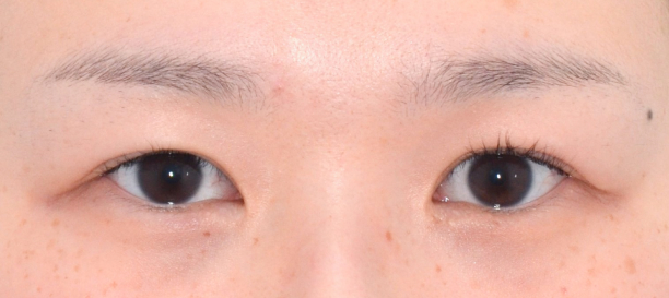 뒤트임, 밑트임 before