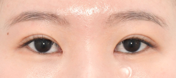 Incision Double Eyelid Surgery, Inner Corner Eye Surgery after