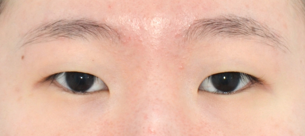 切開法, 目頭切開 before