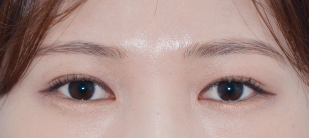 Non-Incision Double Eyelid Surgery, Fat Removal after
