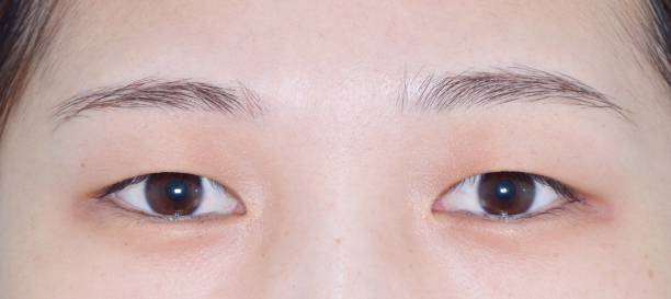 매몰법, 지방제거 before
