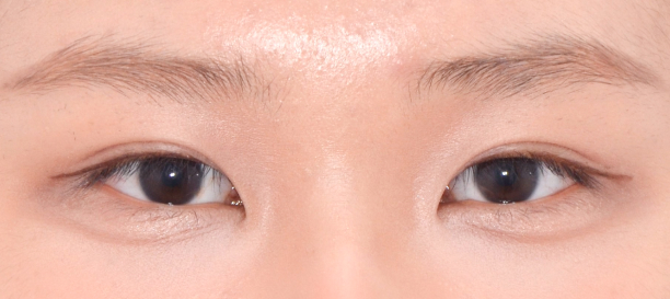Non-Incision Double Eyelid Surgery after