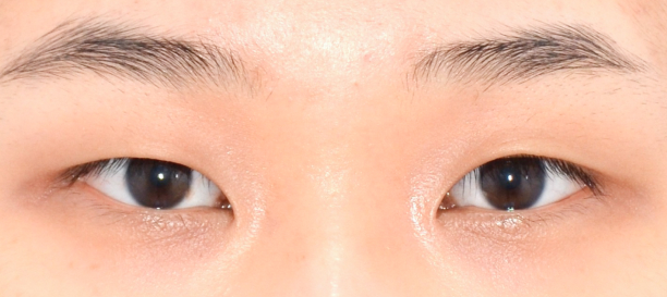 Non-Incision Double Eyelid Surgery before