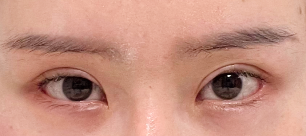 뒤트임, 밑트임, 재수술 after