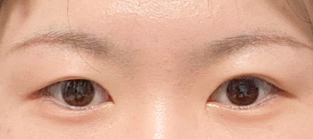 절개법, 뒤트임, 밑트임, 재수술 before