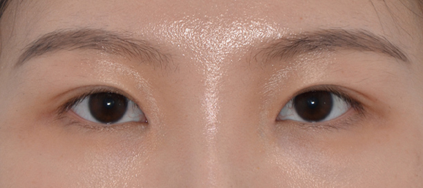 Non-Incision Double Eyelid Surgery, Inner Corner Eye Surgery after