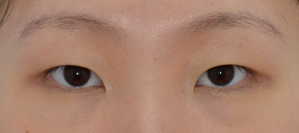 Non-Incision Double Eyelid Surgery, Inner Corner Eye Surgery before