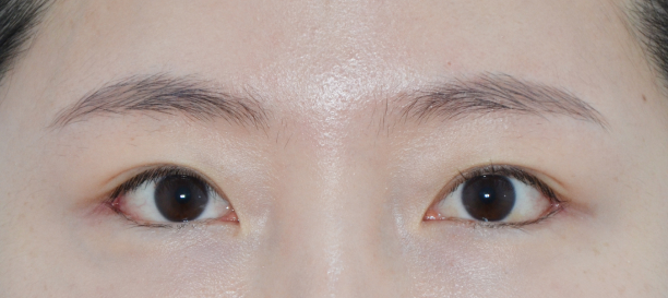 뒤트임, 밑트임 after
