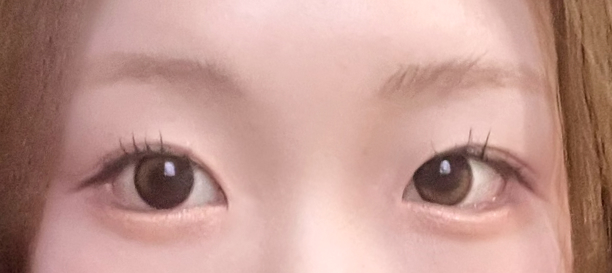 Lateral Canthoplasty, Lower Canthoplasty after