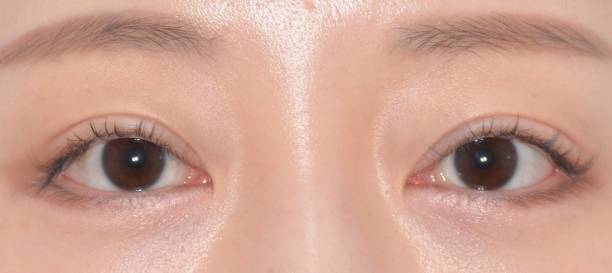 Non-incision Ptosis Correction after