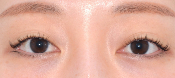 Non-incision Ptosis Correction before