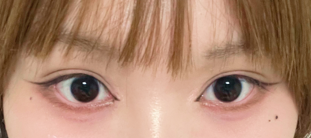 뒤트임, 밑트임 before