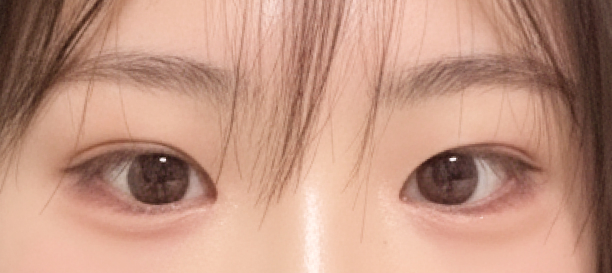 매몰법, 앞트임 after