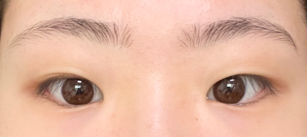 매몰법, 앞트임 before