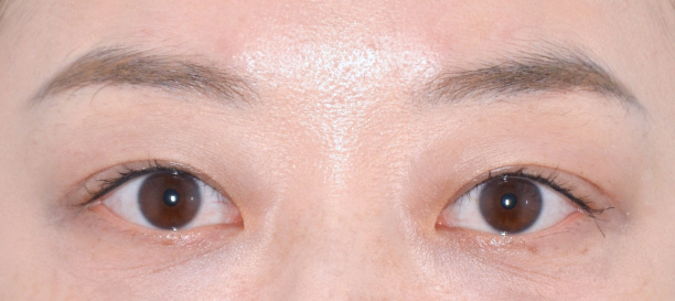 절개눈매교정 before