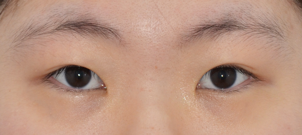 뒤트임, 밑트임 before