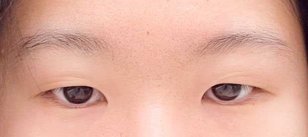 절개눈매교정, 앞트임 before