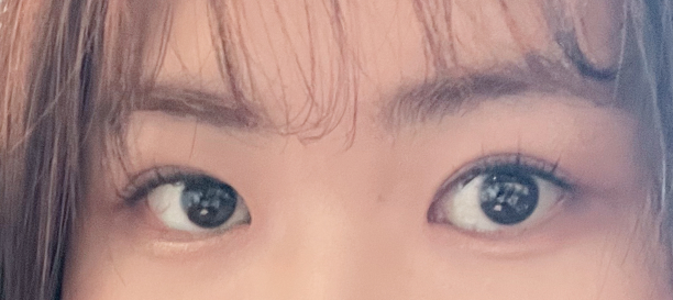 Incision Ptosis Correction, Fat Removal after