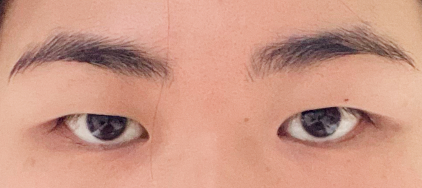 Incision Ptosis Correction, Fat Removal before