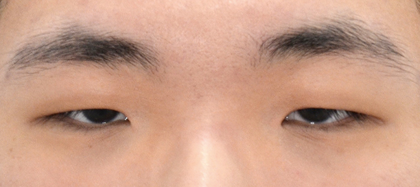 절개눈매교정, 앞트임 before