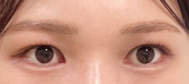 Non-Incision Double Eyelid Surgery, Fat Removal after