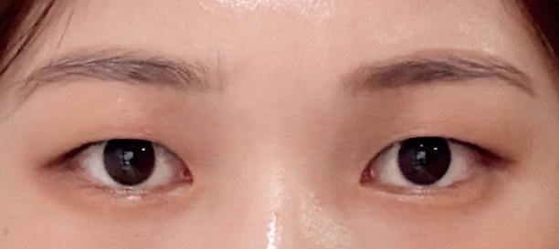 Non-Incision Double Eyelid Surgery, Fat Removal before