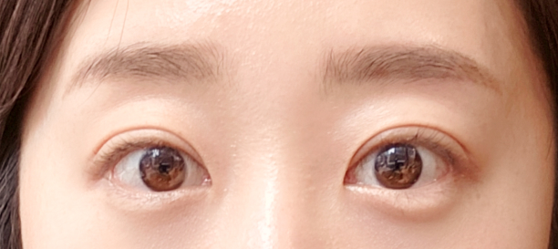 매몰법 after