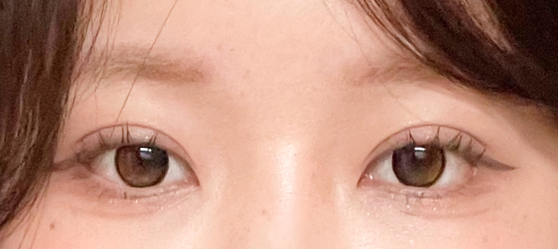 Non-Incision Double Eyelid Surgery, Lateral Canthoplasty, Lower Canthoplasty after