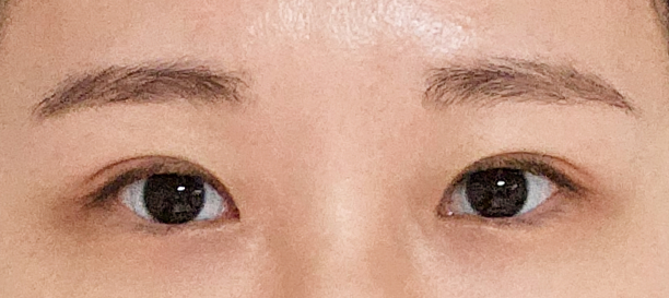 Non-Incision Double Eyelid Surgery, Under-Eye Fat Removal after