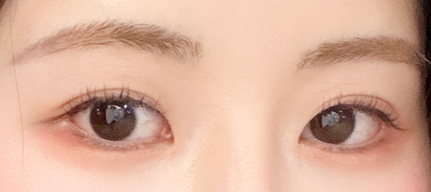 뒤트임, 밑트임 after