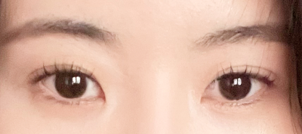 뒤트임, 밑트임 before
