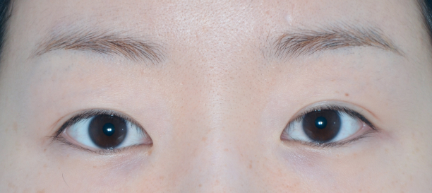 뒤트임, 밑트임 before
