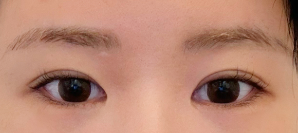 目尻切開, 垂れ目形成 before