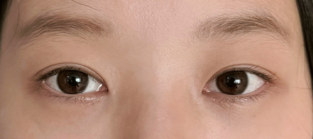 Incision Ptosis Correction, Inner Corner Eye Surgery after