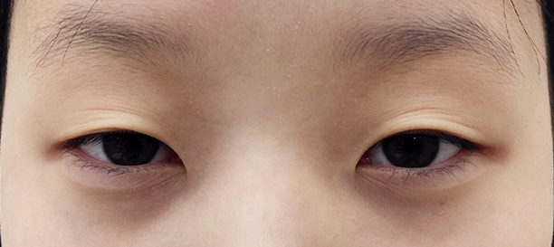 Incision Ptosis Correction, Inner Corner Eye Surgery before