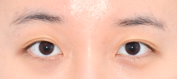 埋没法, 目頭切開 before