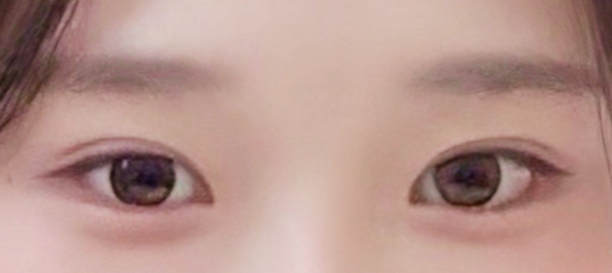 Non-Incision Double Eyelid Surgery, Lateral Canthoplasty, Lower Canthoplasty after