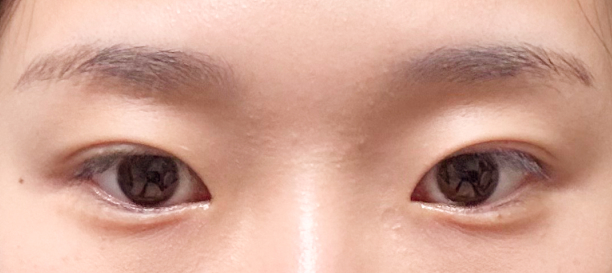 Non-Incision Double Eyelid Surgery, Lateral Canthoplasty, Lower Canthoplasty before