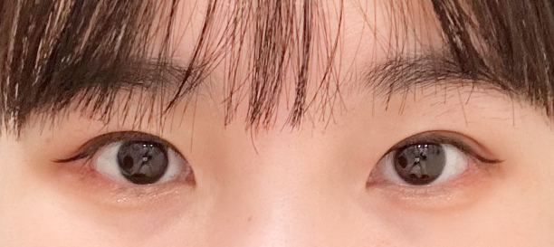 매몰법, 앞트임, 밑트임 before
