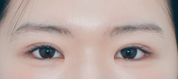 Incision Ptosis Correction, Lateral Canthoplasty, Lower Canthoplasty, Revision Surgery after