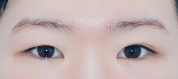 Incision Ptosis Correction, Lateral Canthoplasty, Lower Canthoplasty, Revision Surgery before