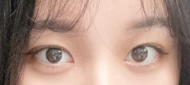 매몰법, 앞트임 after