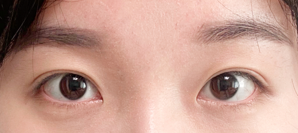 埋没法, 目頭切開 before