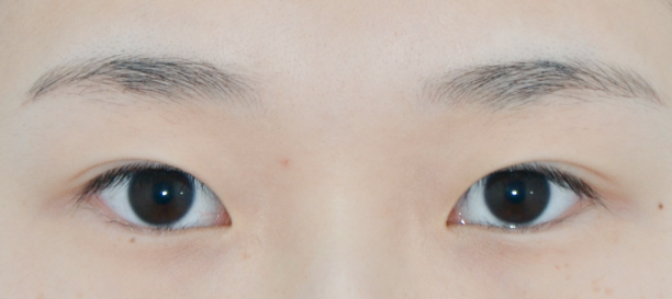 매몰법, 뒤트임, 밑트임 before
