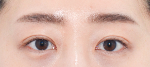 매몰법 after