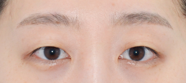 매몰법 before