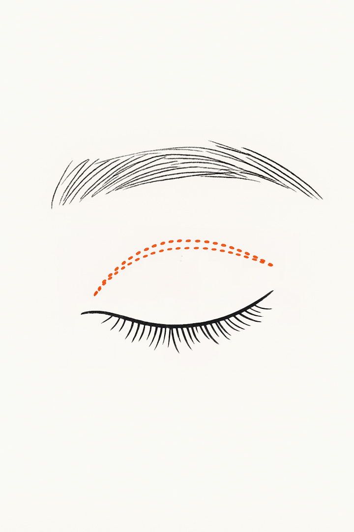 비절개 눈매교정 과정 01