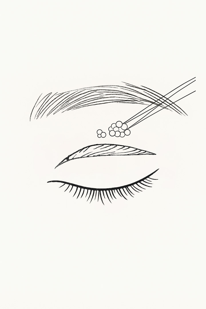 비절개 눈매교정 과정 02