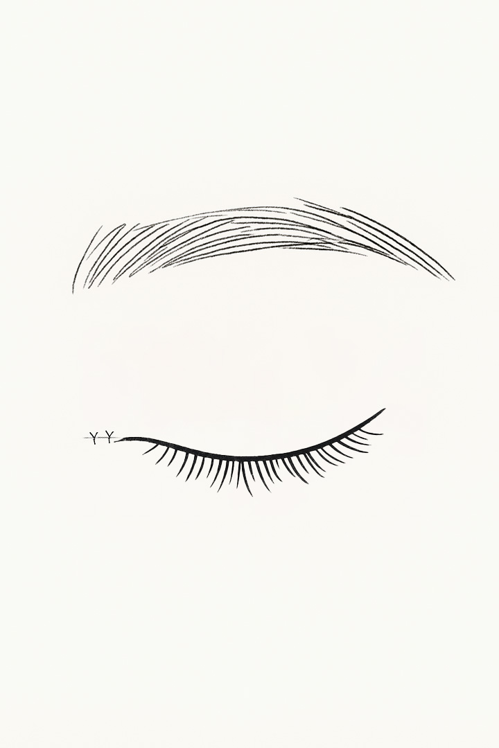 The two points[m] are pulled[d] together[m] and sutured,[d] removing[m] excess skin.